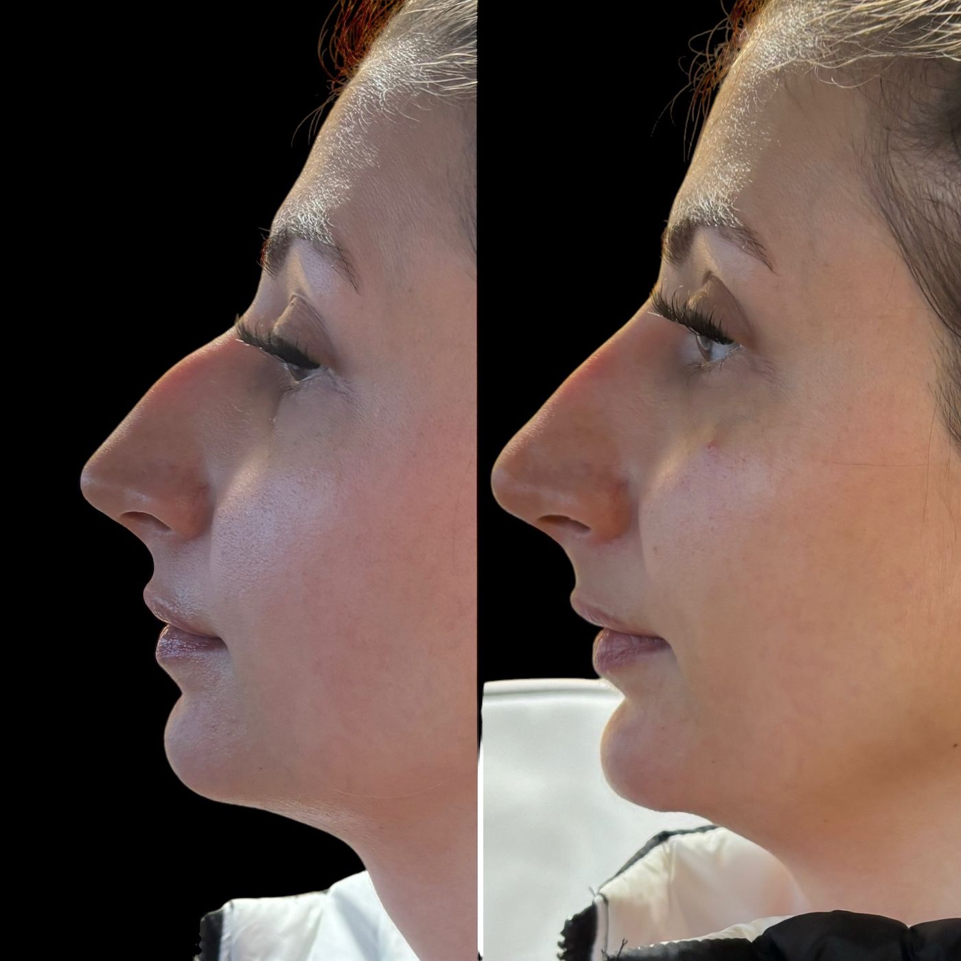 Before and after nose