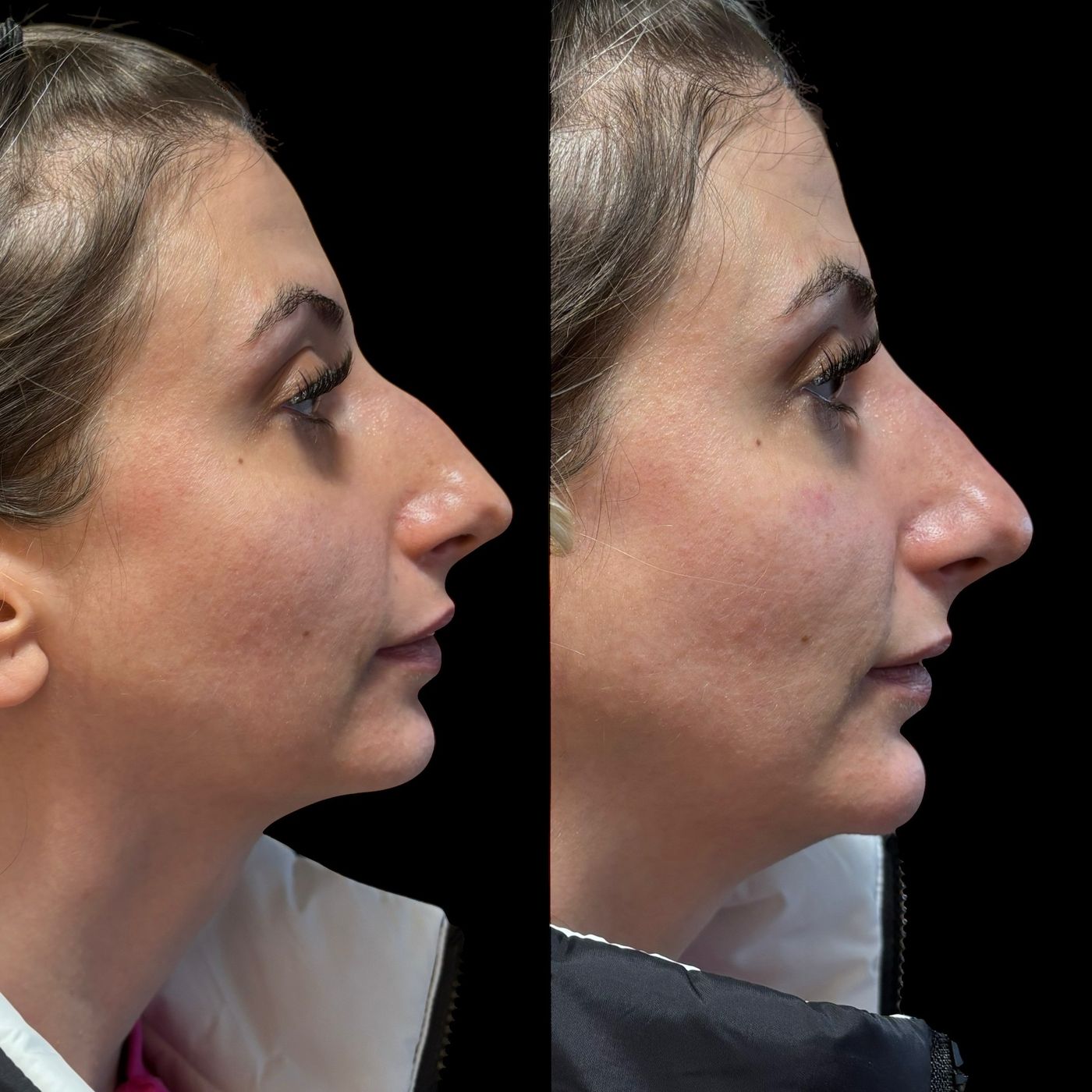 Before and after nose