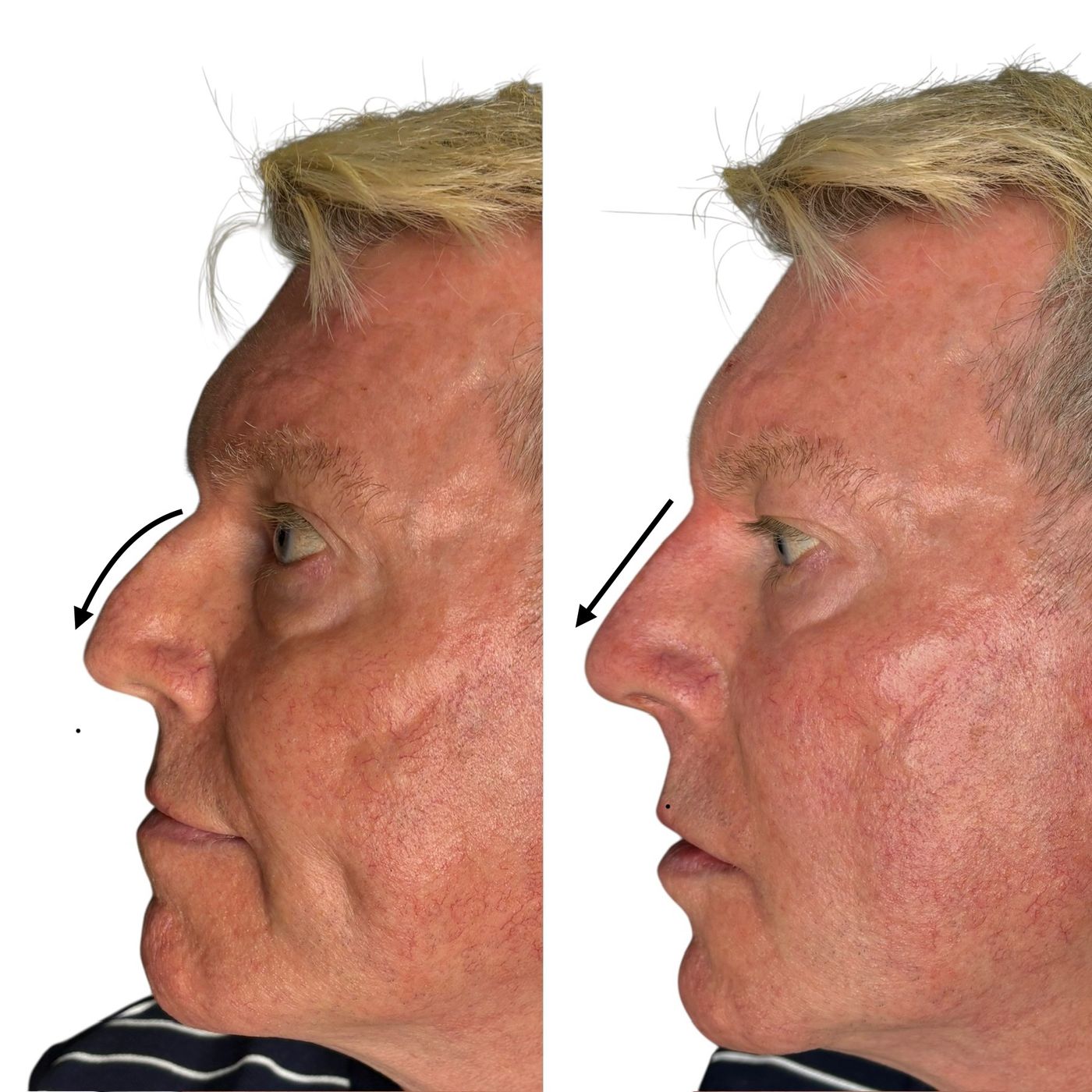 Before and after nose