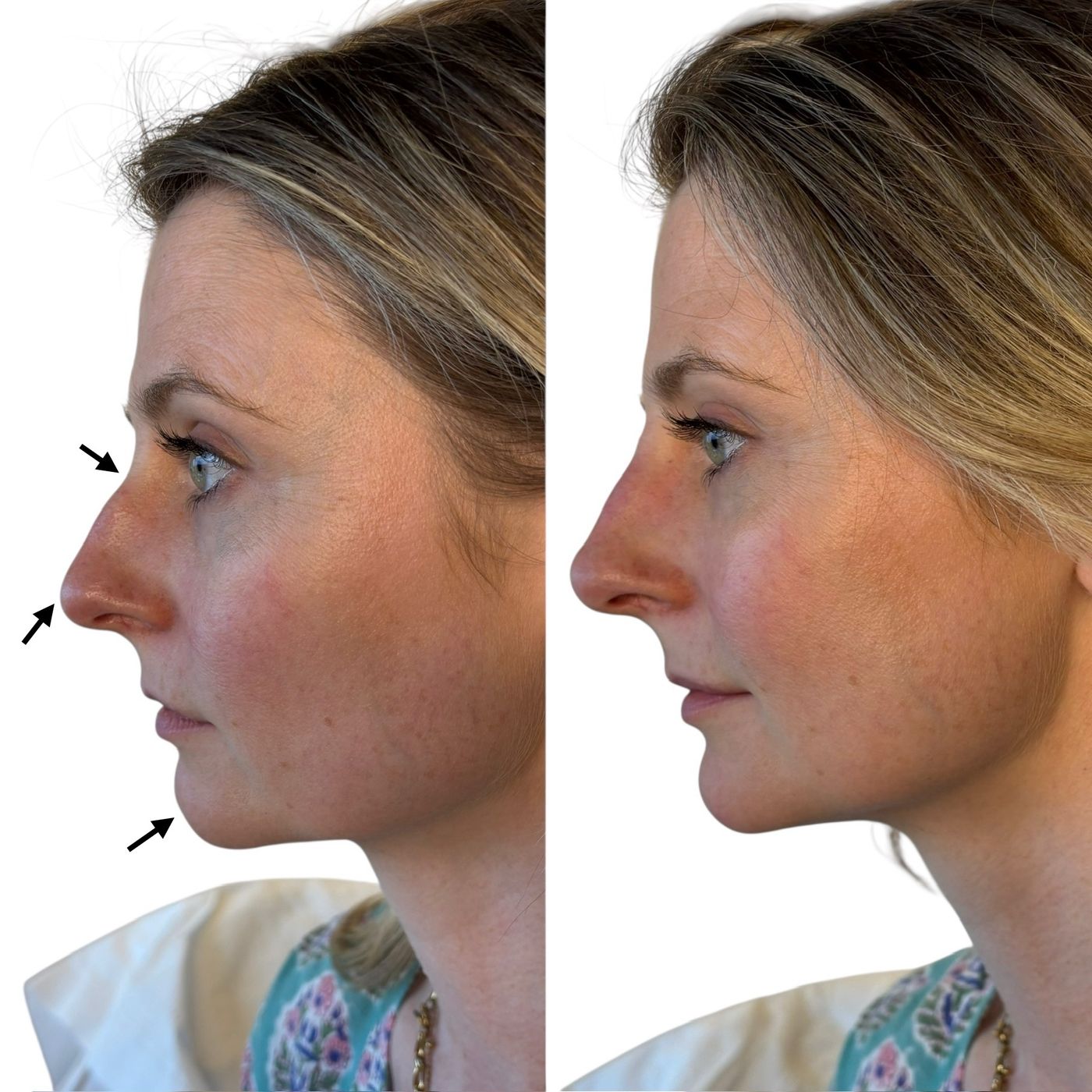 Before and after nose