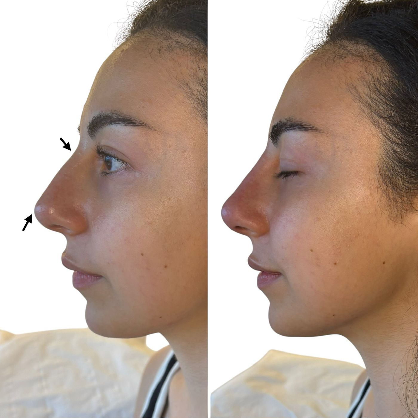 Before and after nose