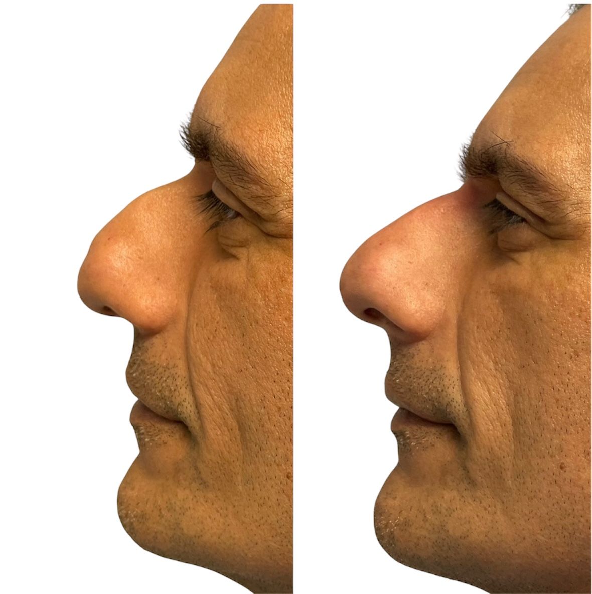 Before and after nose