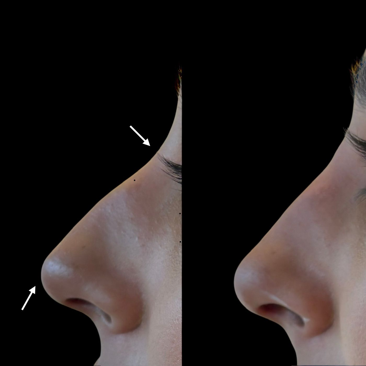 Before and after nose