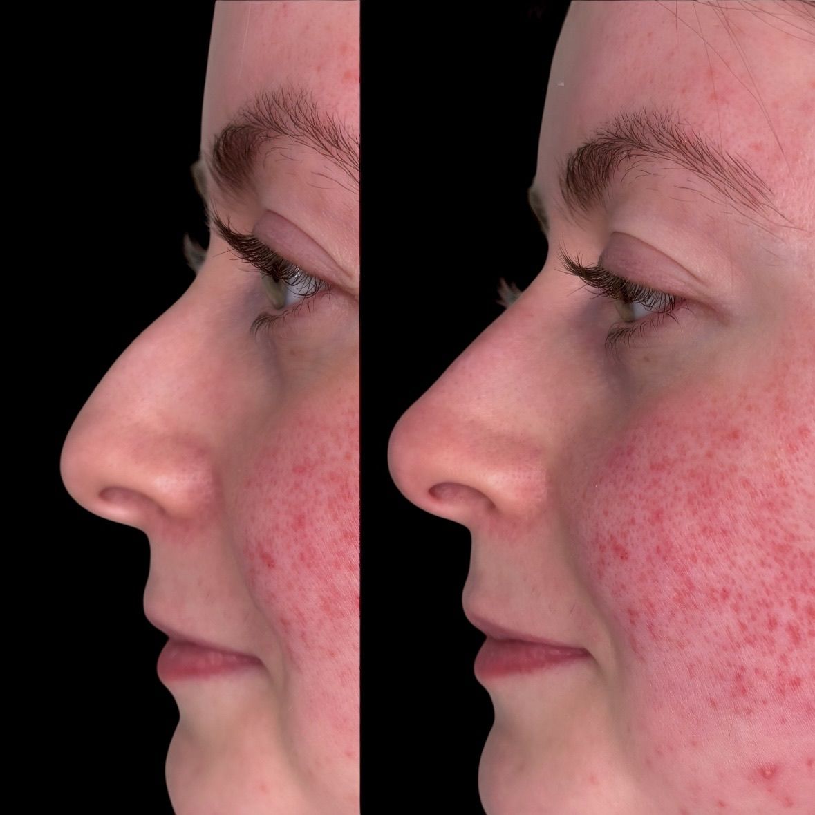 Before and after nose