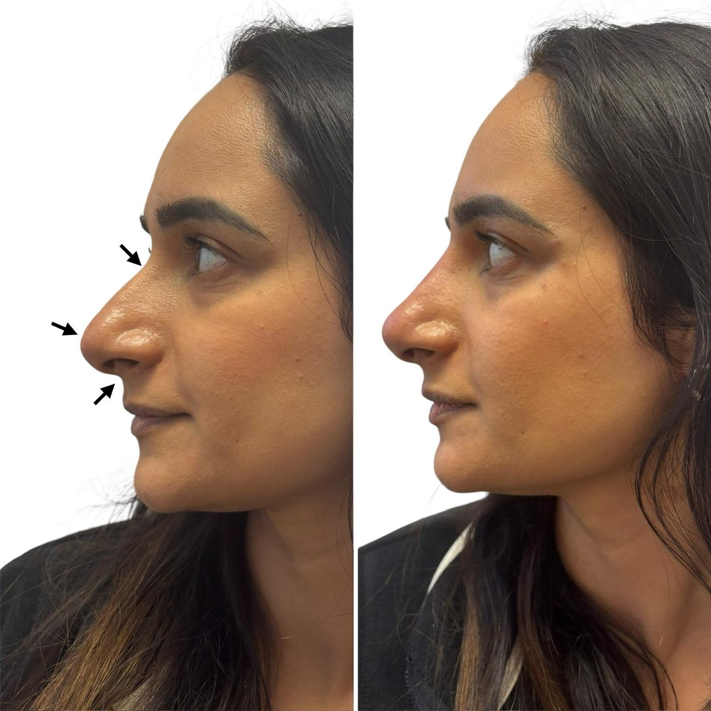Before and after nose