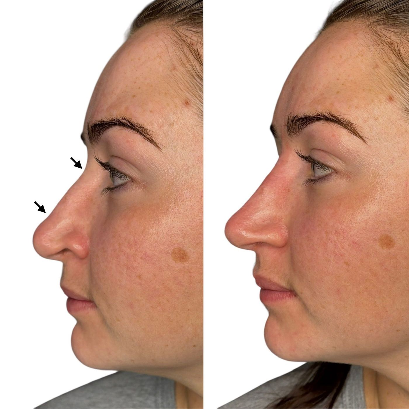 Before and after nose