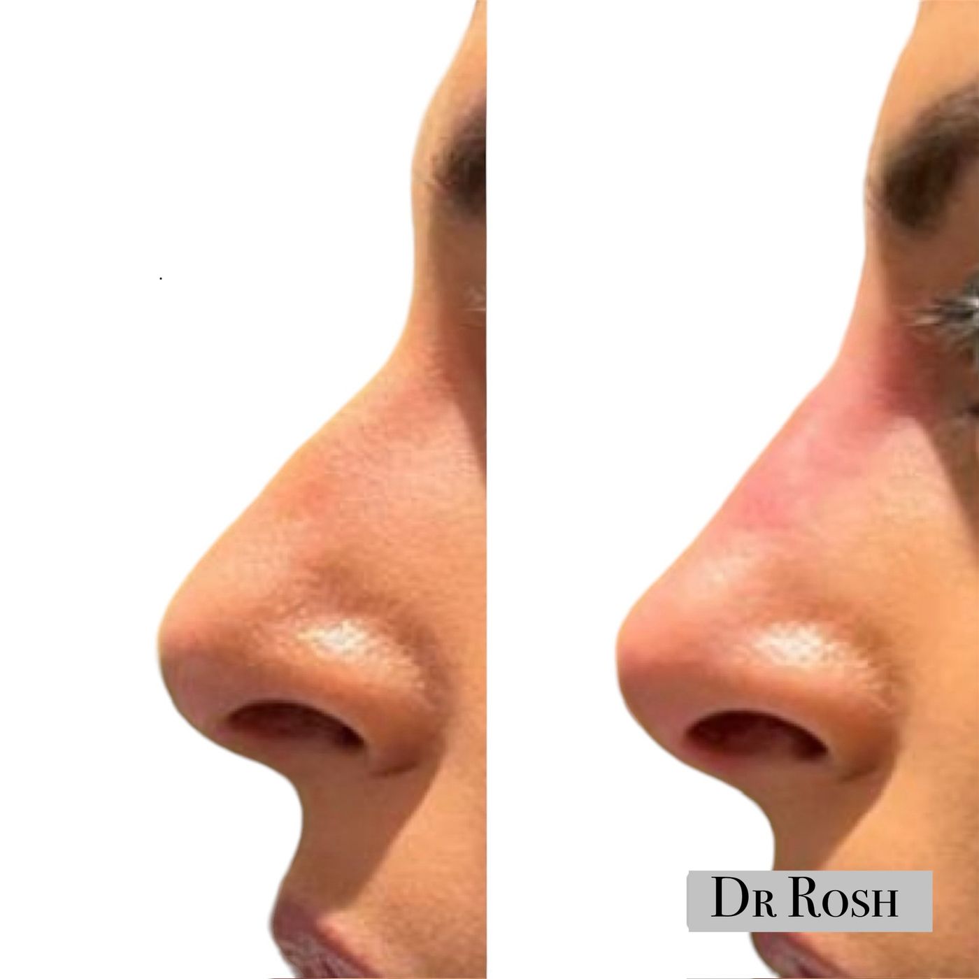 Before and after nose