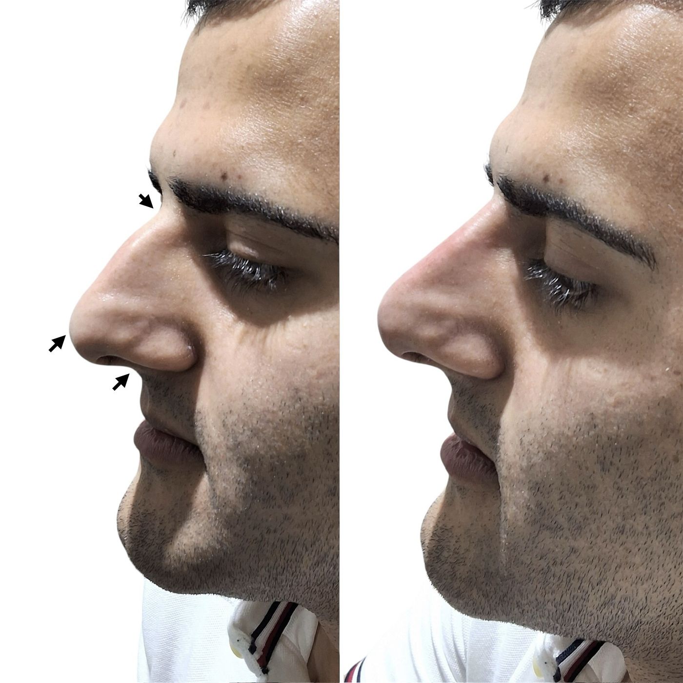 Before and after nose
