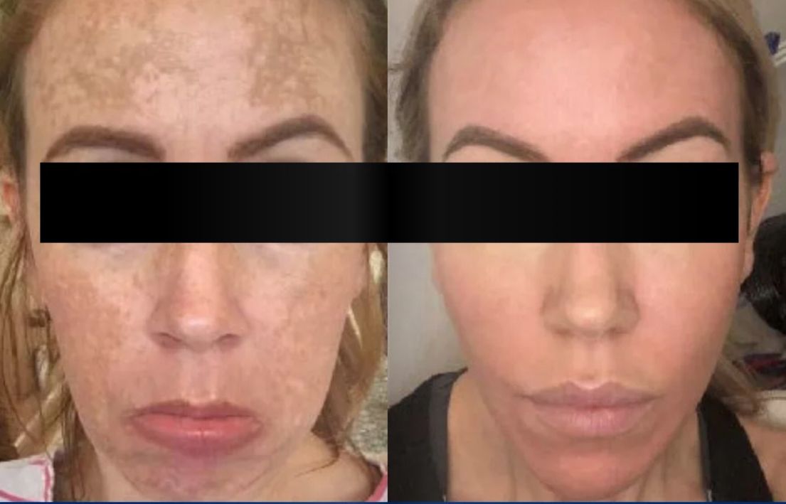 Before and after skincare
