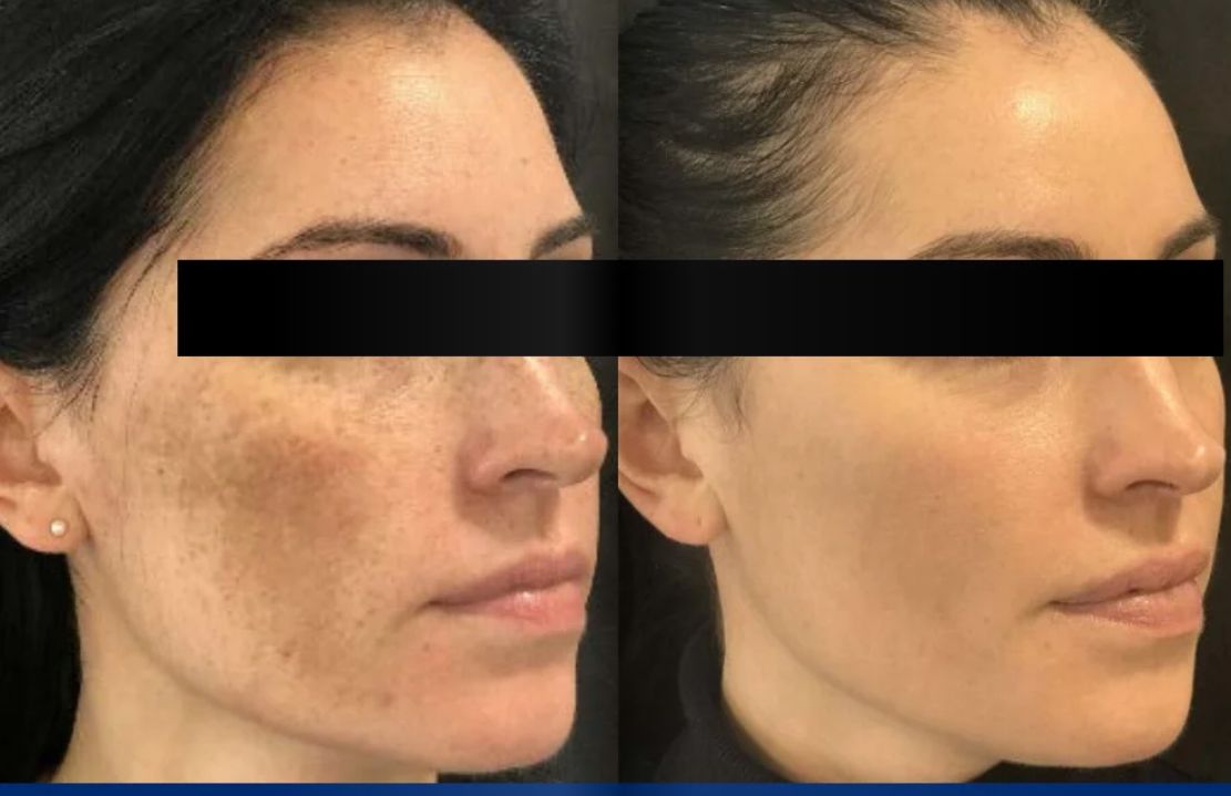 Before and after skincare