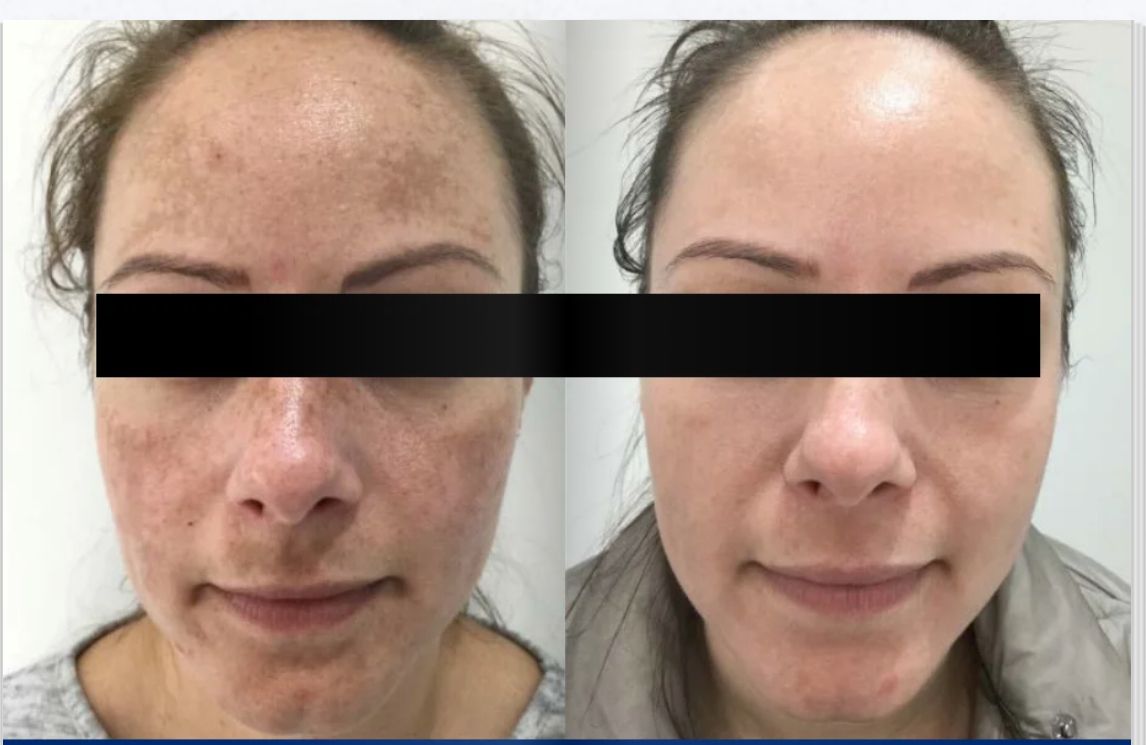 Before and after skincare