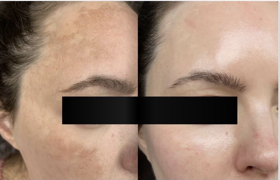Before and after skincare