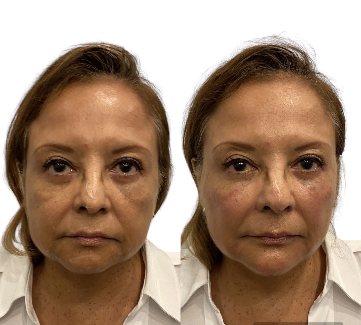 Before and after structural rejuvenation