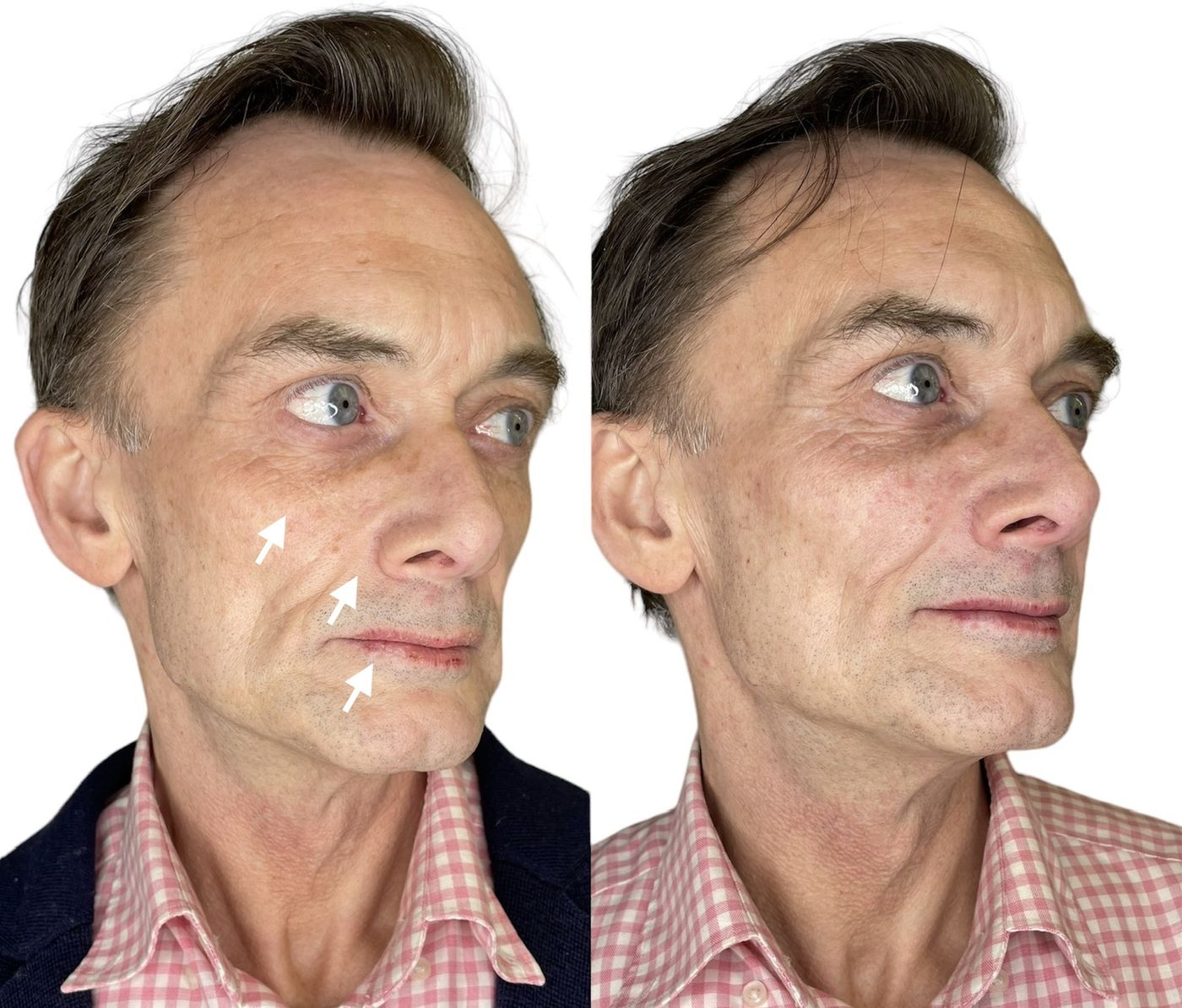 Before and after structural rejuvenation