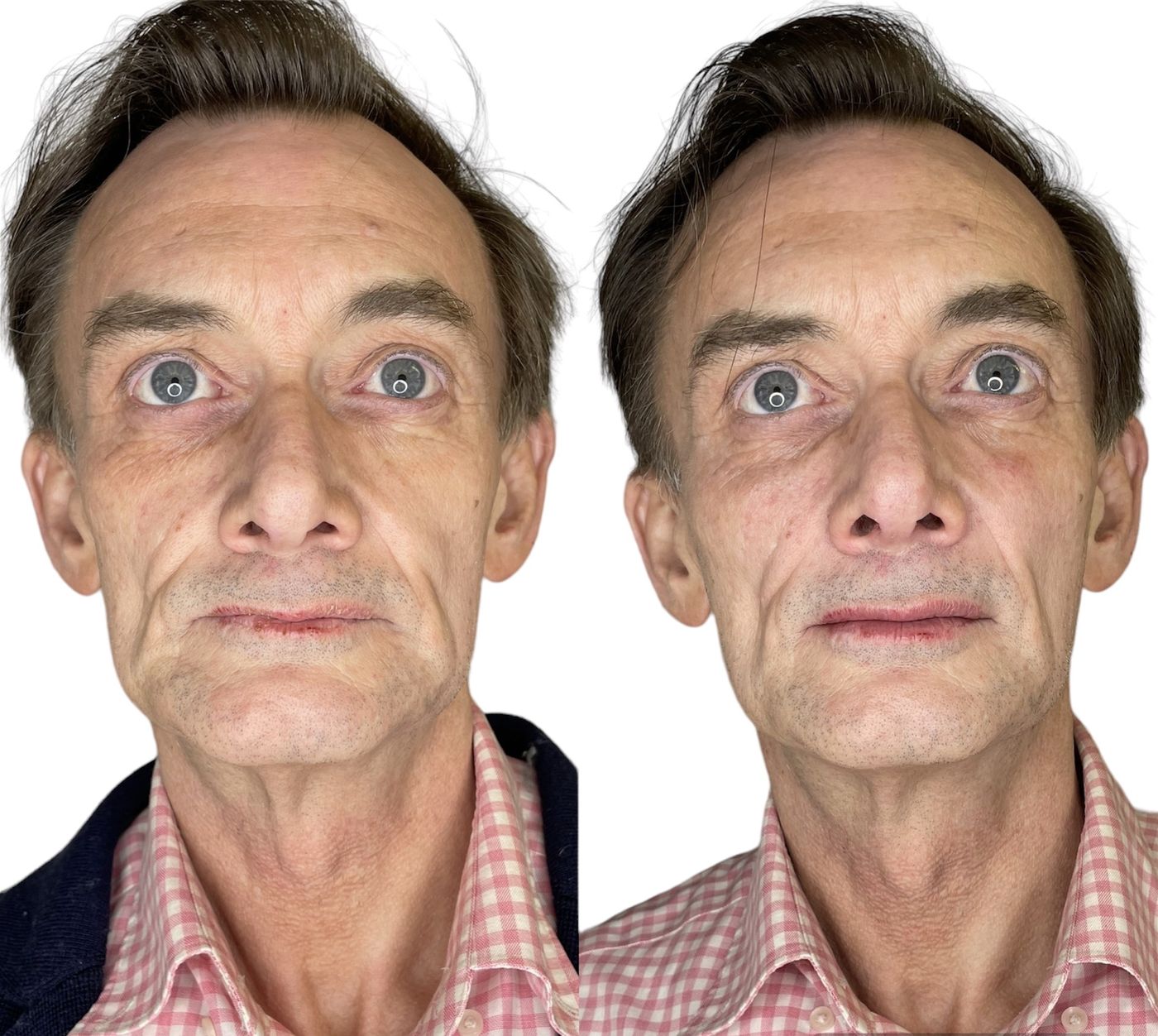 Before and after structural rejuvenation