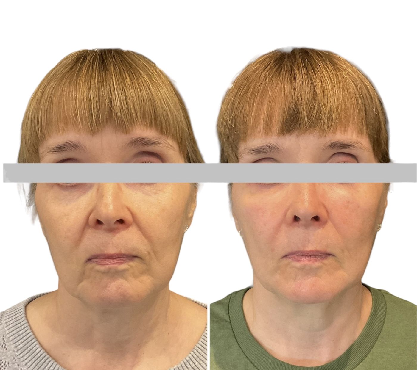 Before and after structural rejuvenation