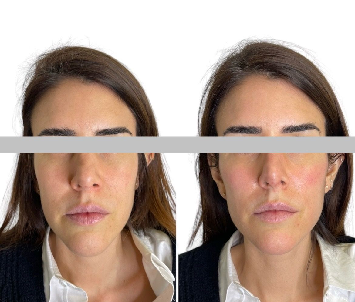 Before and after structural rejuvenation