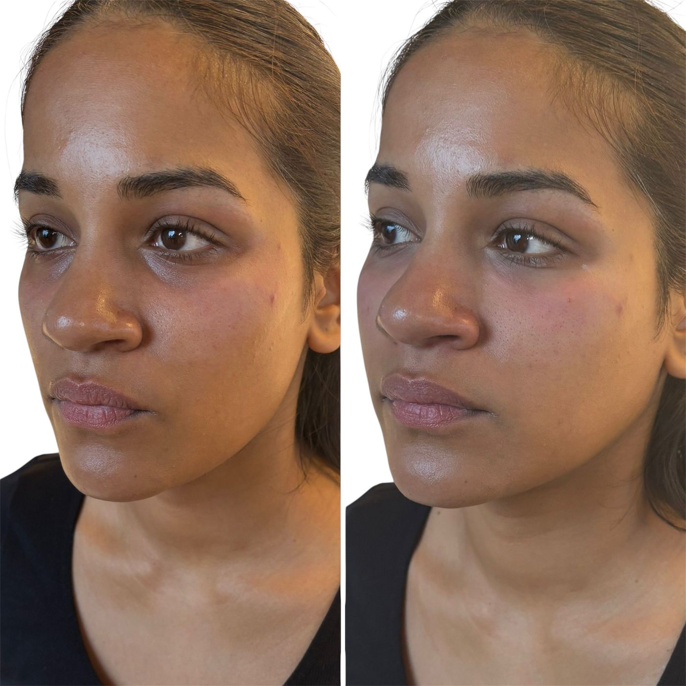 Before and after structural rejuvenation