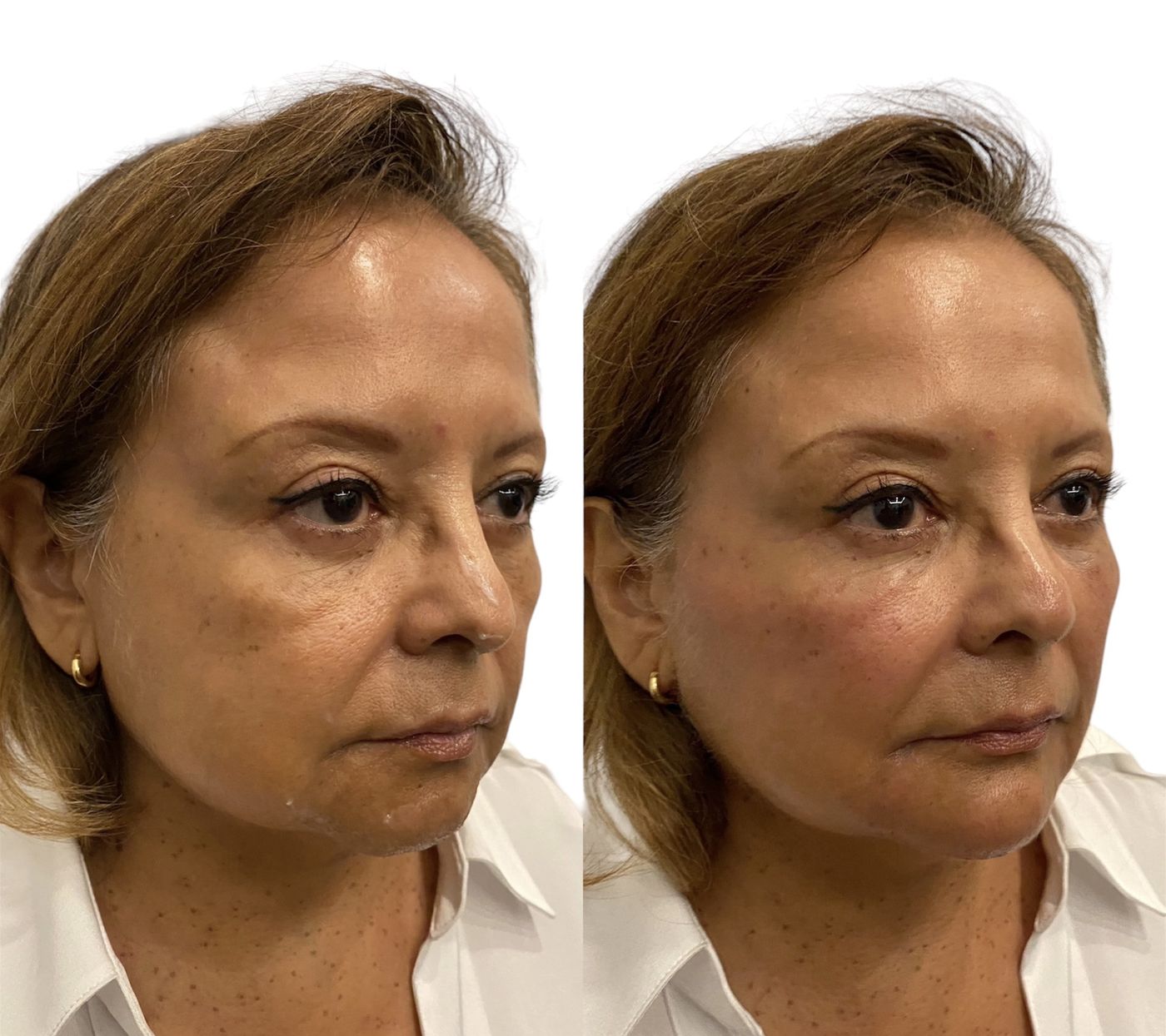 Before and after structural rejuvenation