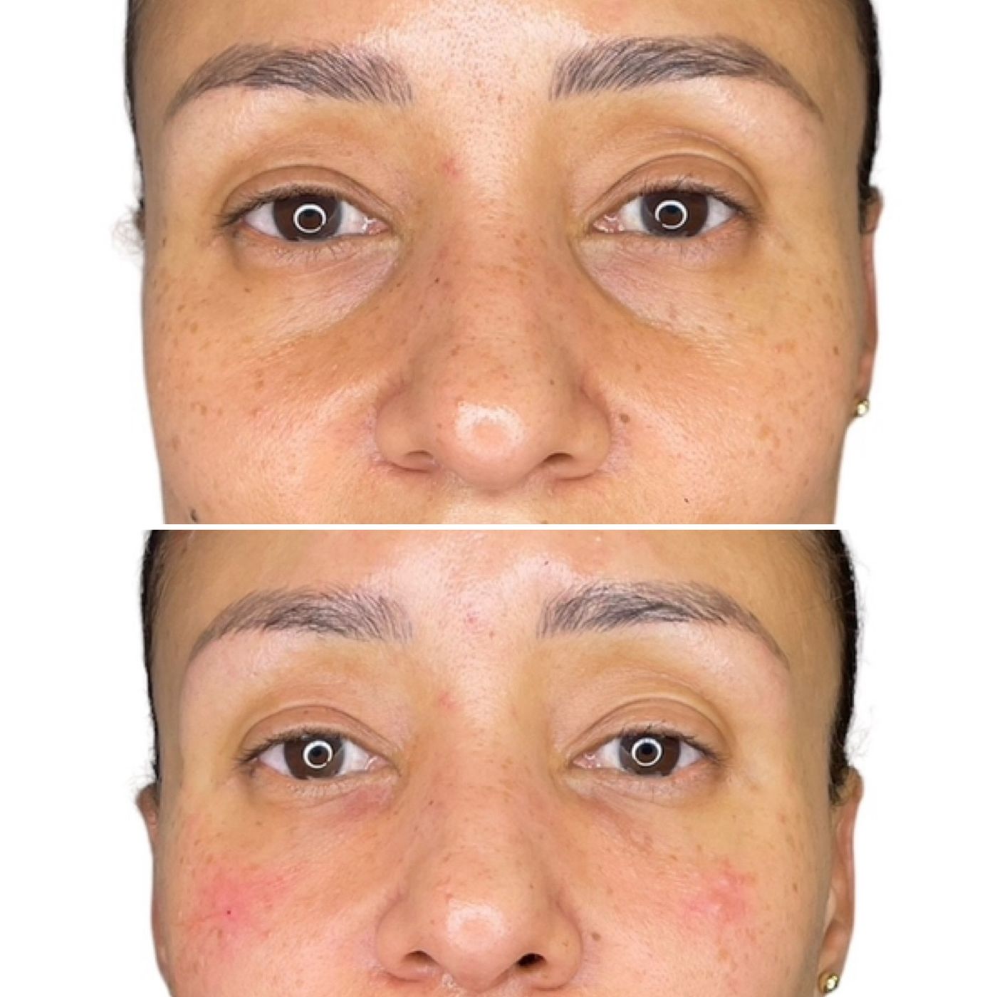 Before and after tear trough