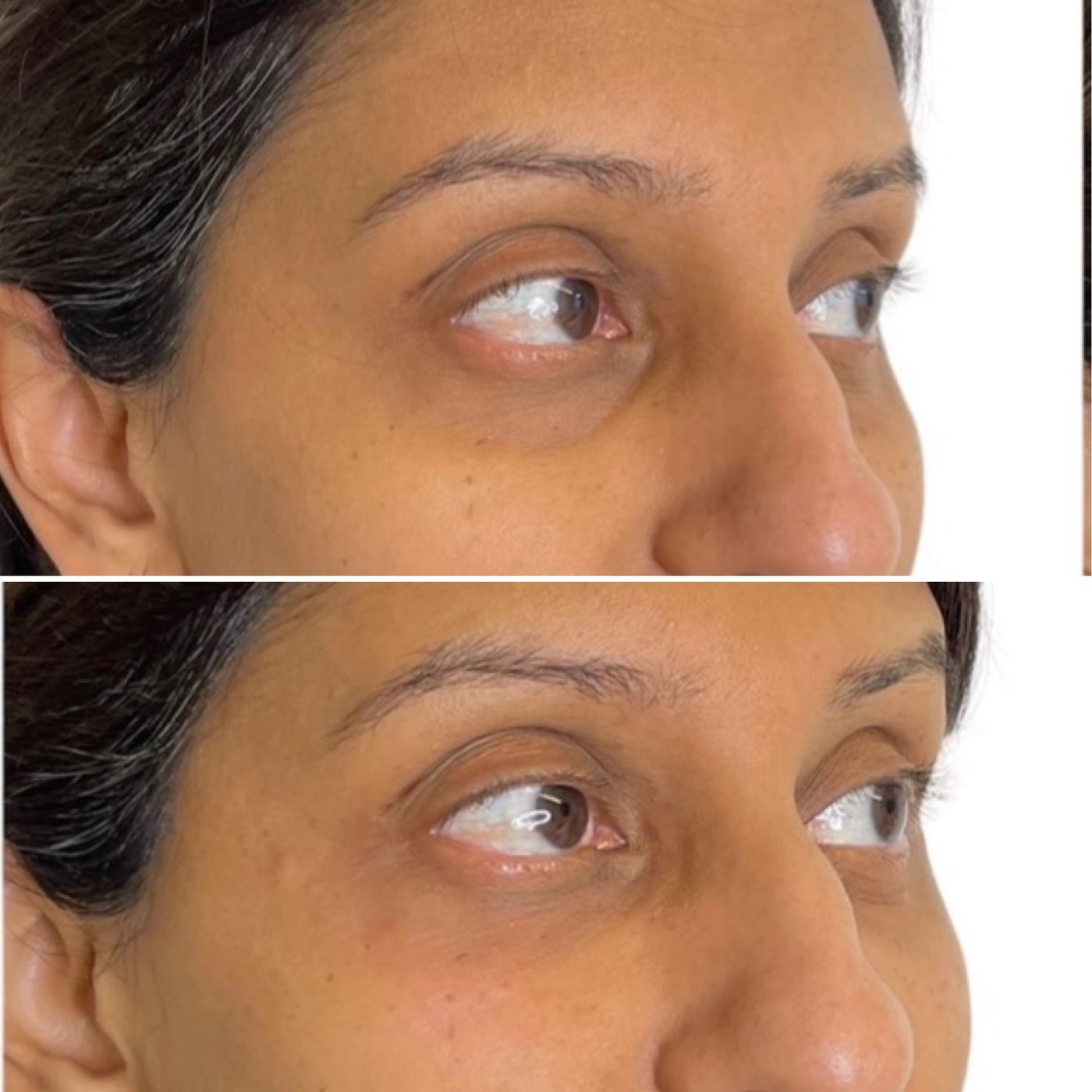 Before and after tear trough