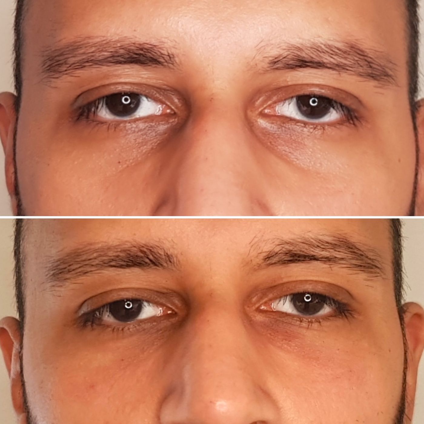Before and after tear trough