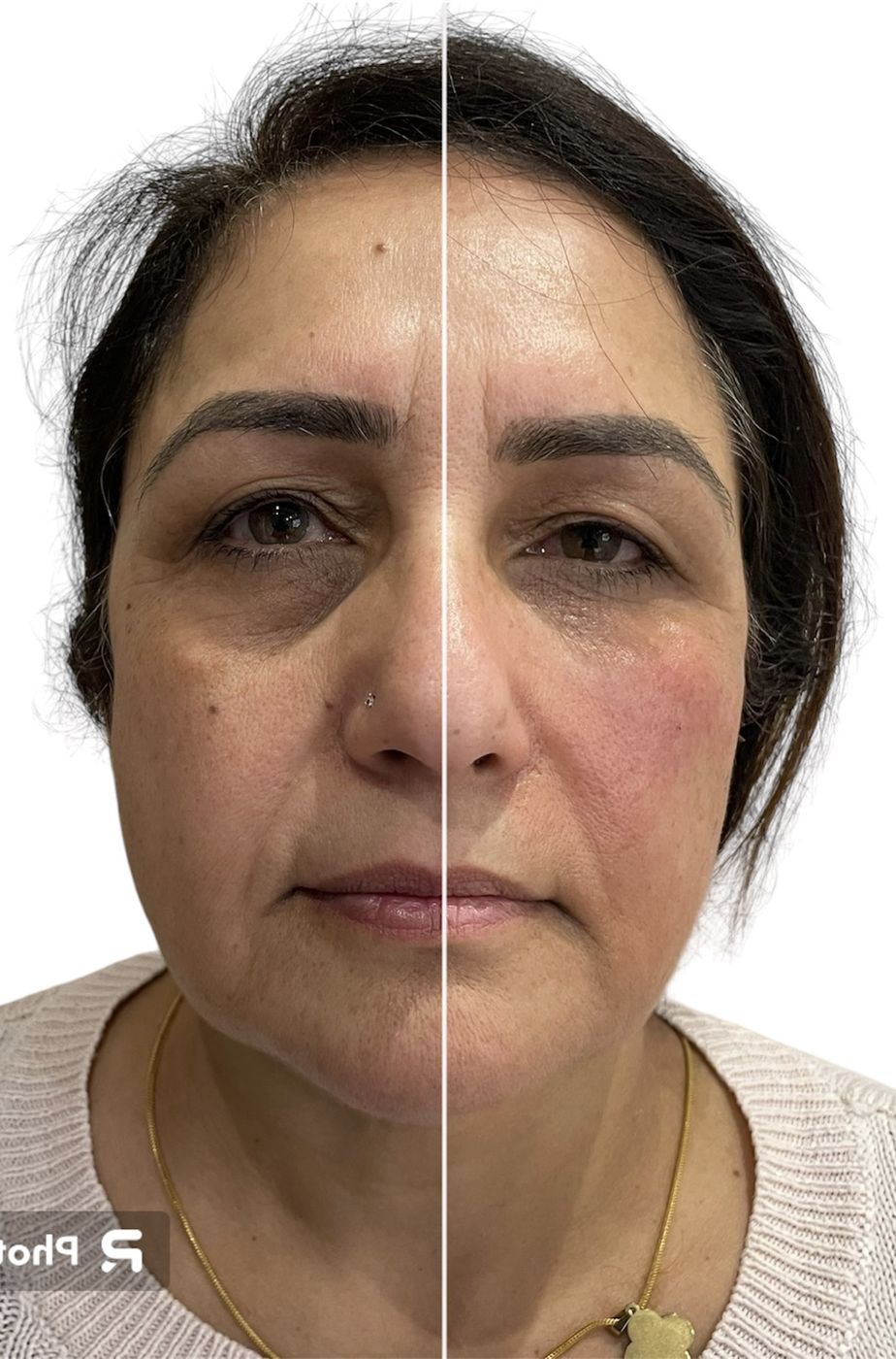 Before and after tear trough