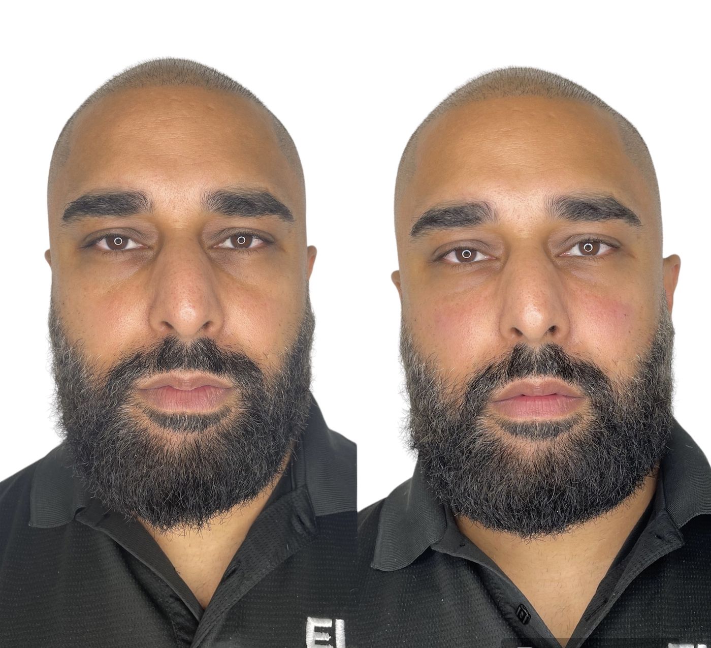 Before and after tear trough