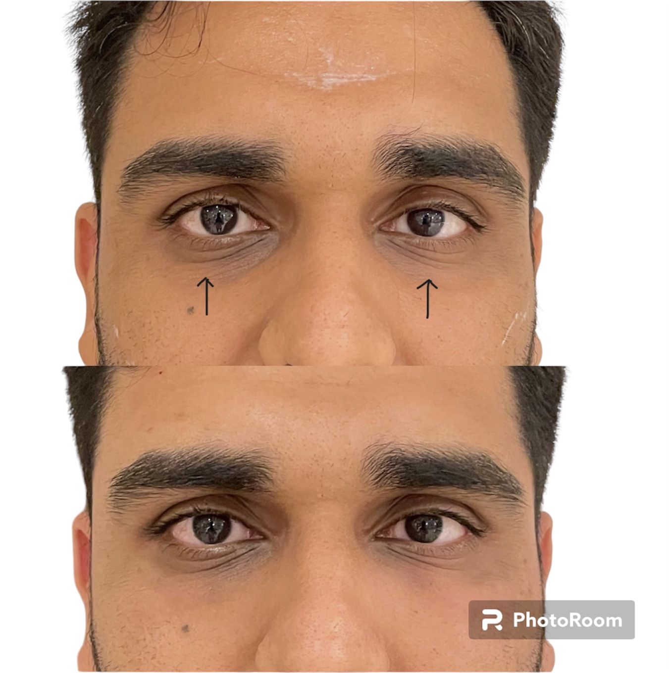 Before and after tear trough