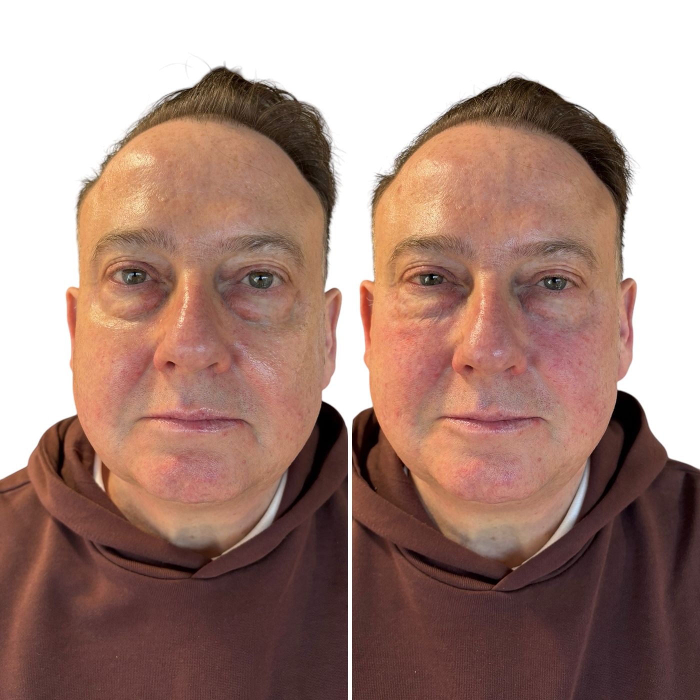 Before and after tear trough