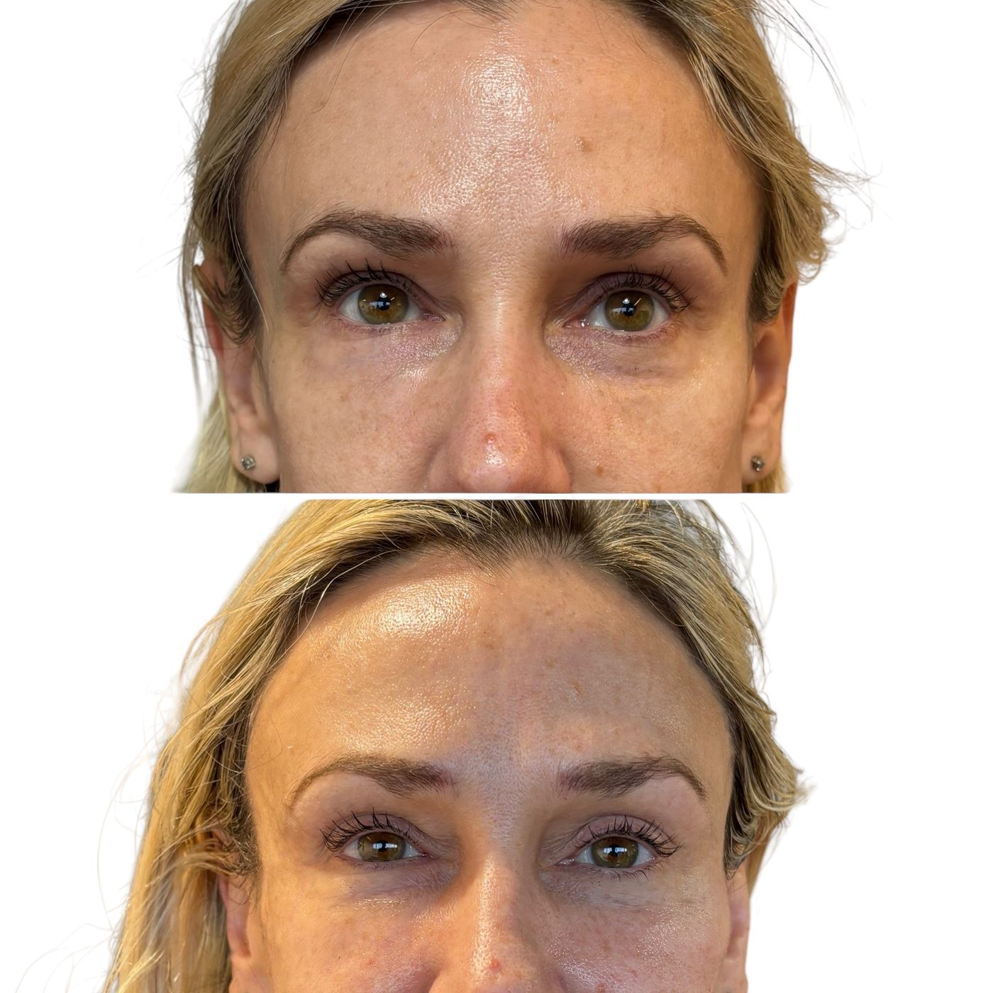 Before and after tear trough