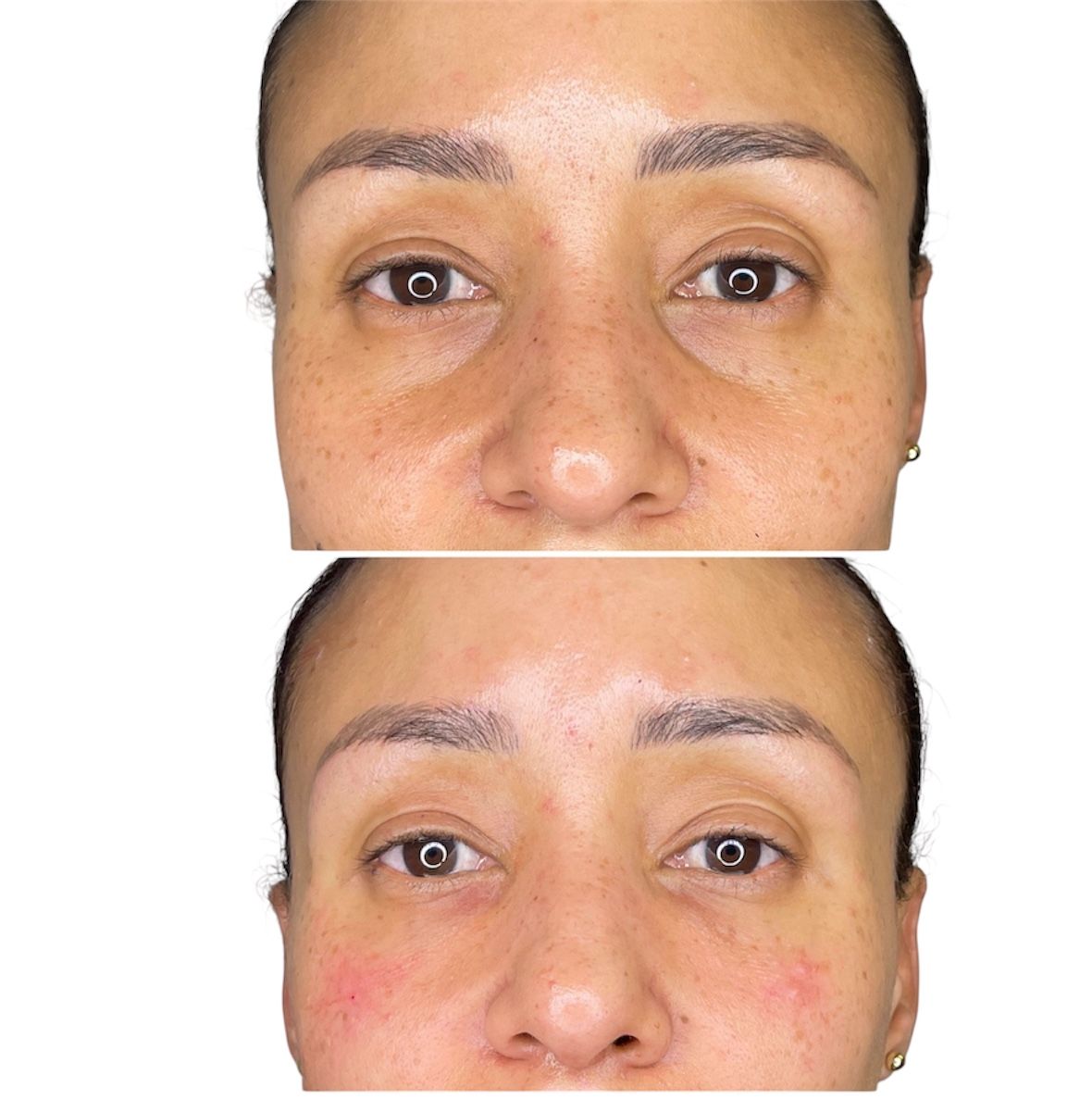 Before and after tear trough