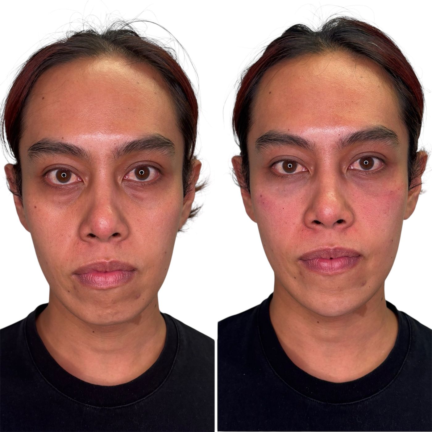 Before and after tear trough