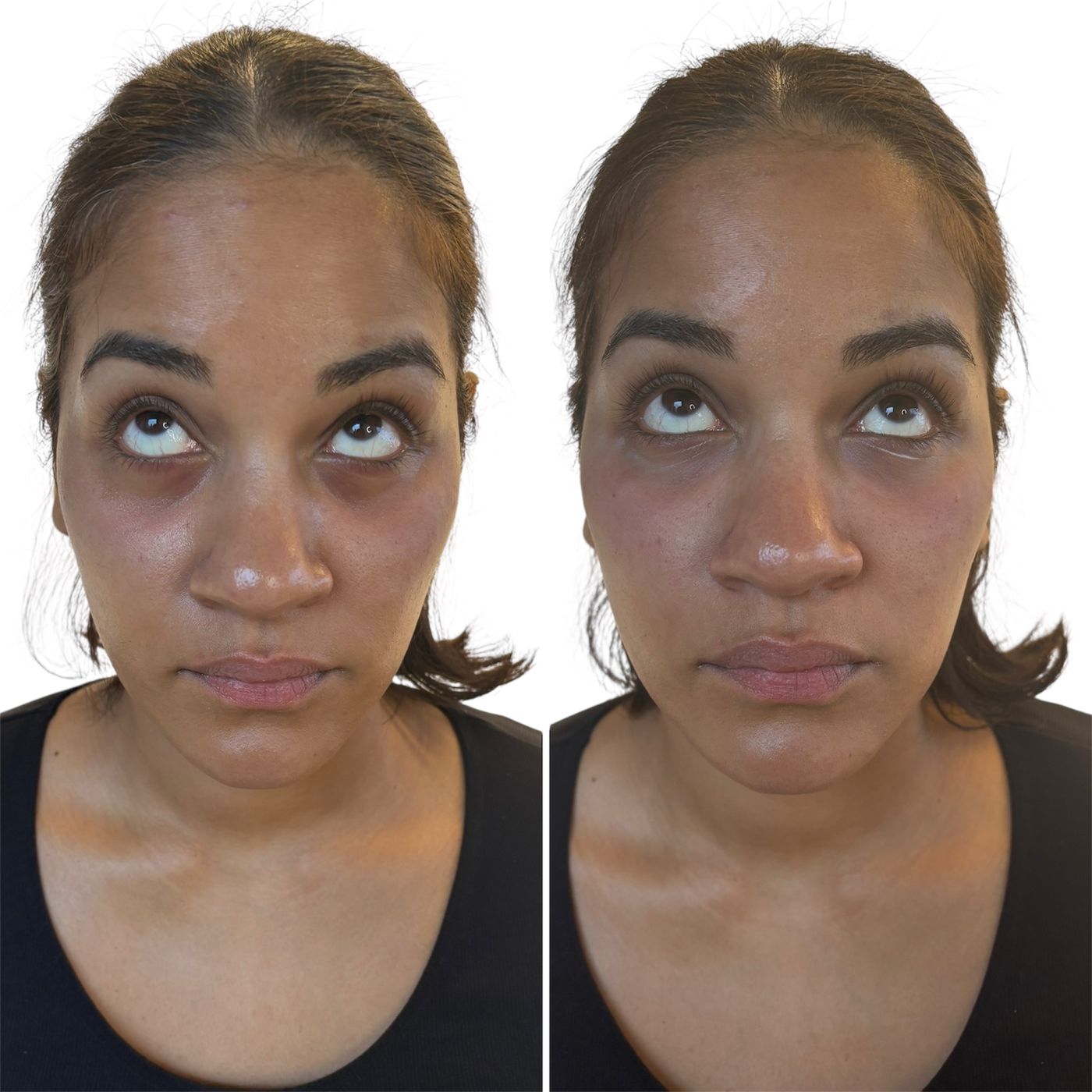 Before and after tear trough