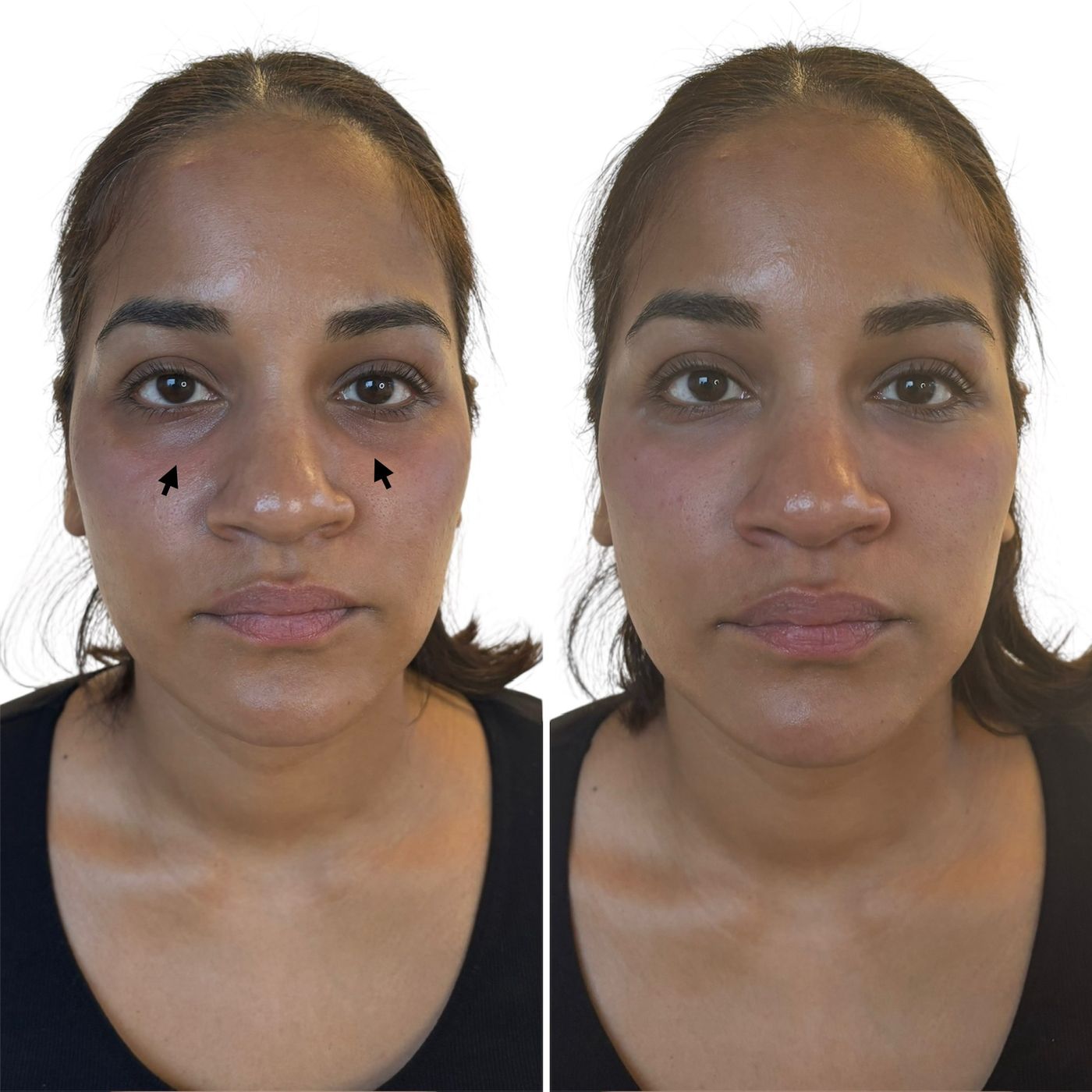 Before and after tear trough