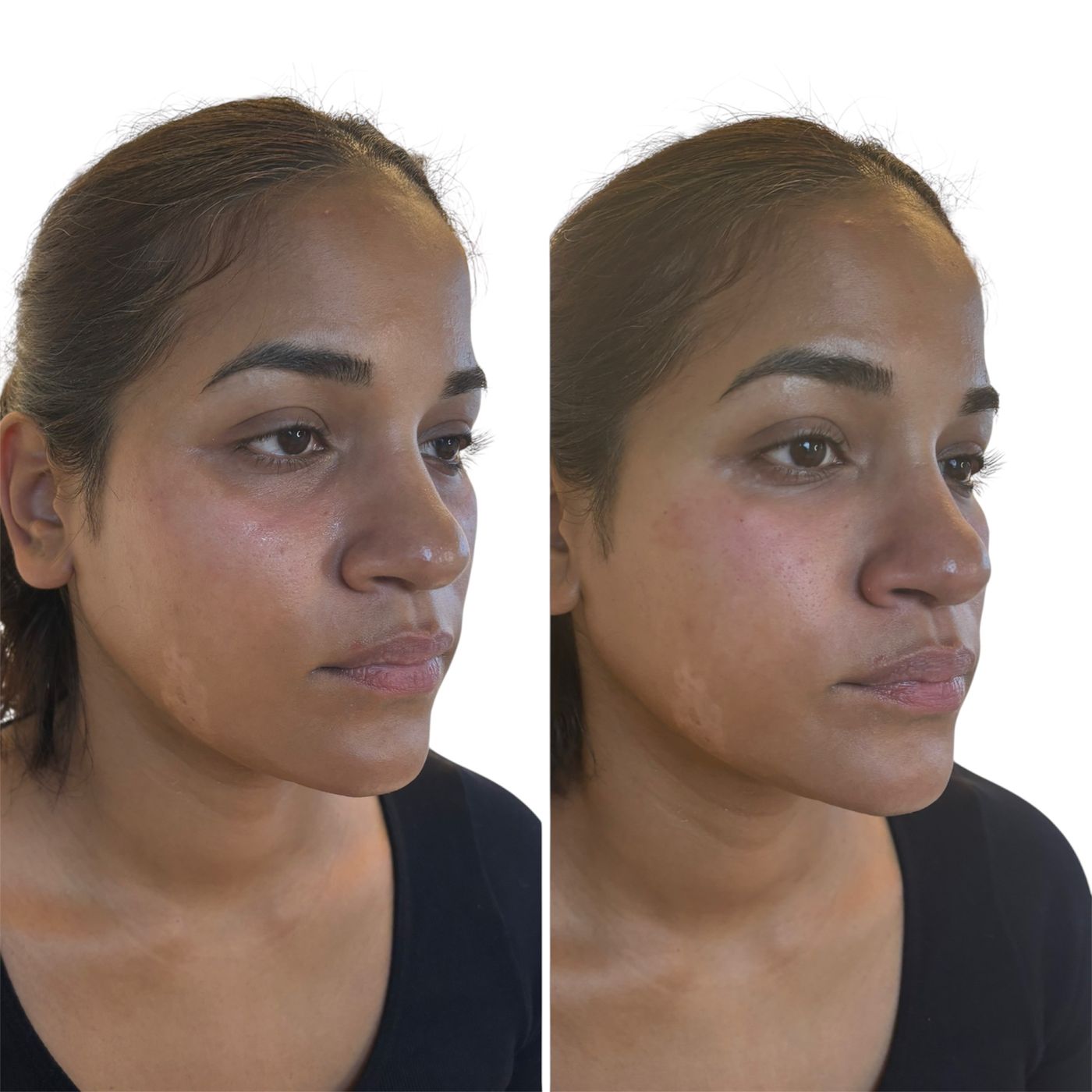 Before and after tear trough
