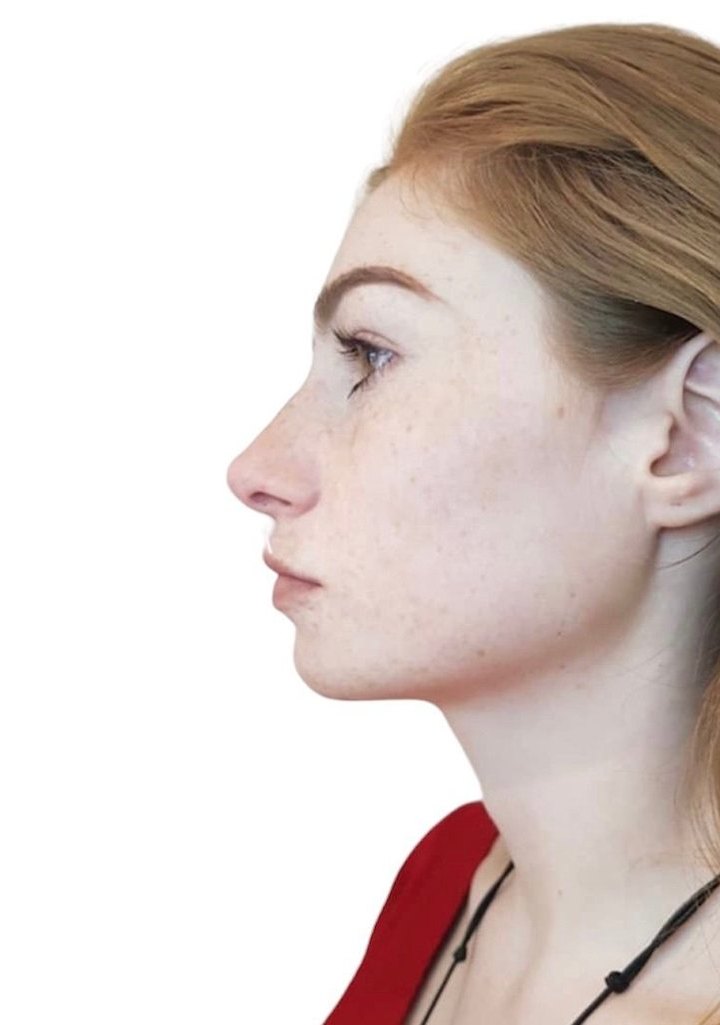 After nose
