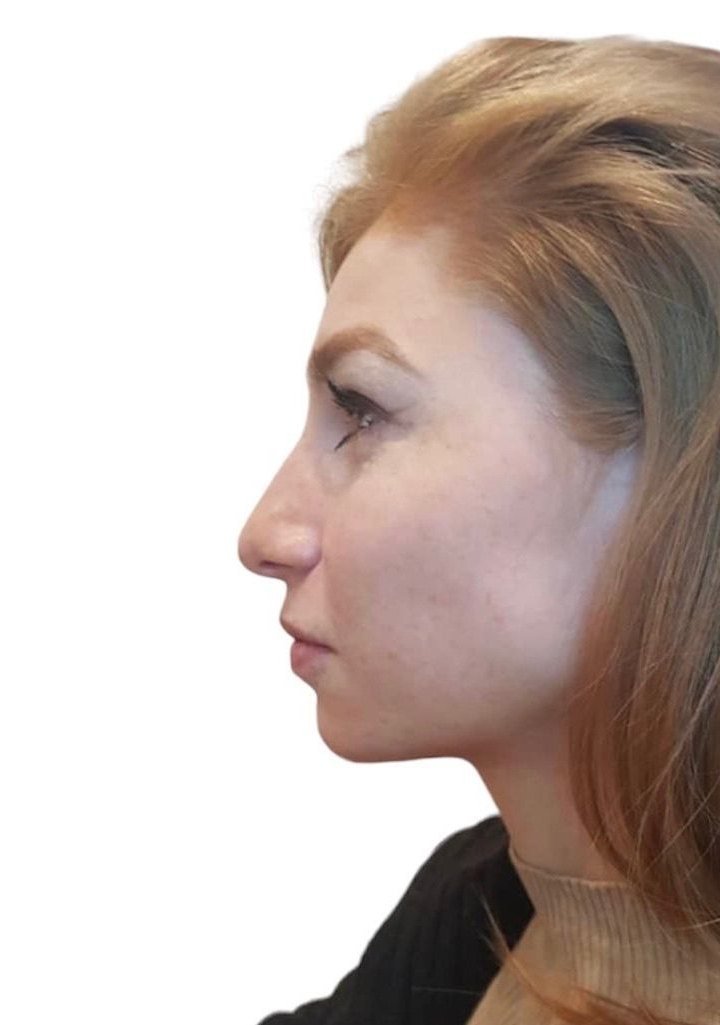 Before nose